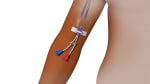 Care in the Hospital: Central Vascular Access Device (CVAD)