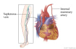 Location of saphenous vein in leg, and heart showing saphenous vein and an internal mammary artery used to bypass the diseased coronary artery.