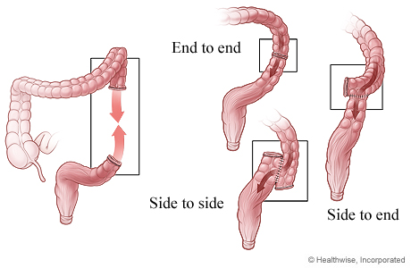 Three ways that colon ends can be reattached after surgery.