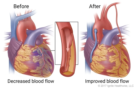 Decreased blood flow caused by narrowed or blocked artery before surgery and improved blood flow after surgery.