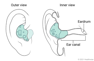 Outer and inner views of in-the-ear hearing aid placed in ear. Outer and inner views of in-the-ear hearing aid placed in ear.