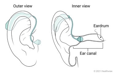 Outer and inner view of mini BTE hearing aid placed in ear. Outer and inner view of mini BTE hearing aid placed in ear.