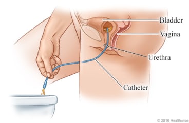 Side view showing urine draining through the catheter, from the bladder into the toilet. Side view showing urine draining through the catheter, from the bladder into the toilet.