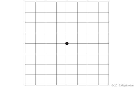 Normal Amsler grid.