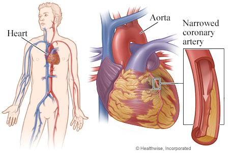 Heart, with detail of coronary artery narrowed by plaque Heart, with detail of coronary artery narrowed by plaque