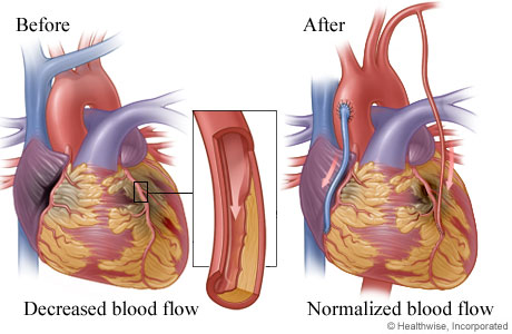 Decreased blood flow caused by narrowed or blocked artery before surgery and improved blood flow after surgery Decreased blood flow caused by narrowed or blocked artery before surgery and improved blood flow after surgery