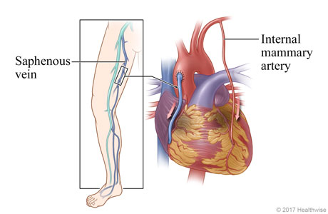 Location of saphenous vein in leg, and heart showing saphenous vein and an internal mammary artery used to bypass the diseased coronary artery Location of saphenous vein in leg, and heart showing saphenous vein and an internal mammary artery used to bypass the diseased coronary artery