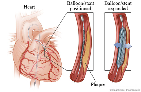 Balloon and stent positioned and expanded Balloon and stent positioned and expanded