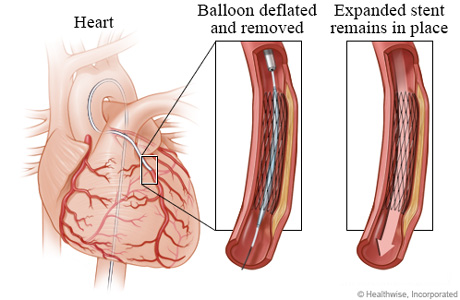 Deflated balloon leaving an expanded stent in place Deflated balloon leaving an expanded stent in place