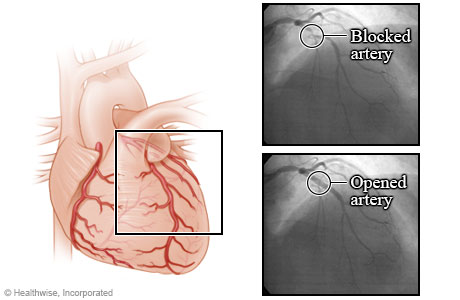 Arteries before and after an angioplasty Arteries before and after an angioplasty